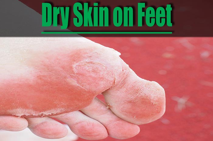 Dry Skin on Feet